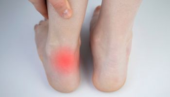Achilles tendon rupture | Experienced Idaho Podiatrist