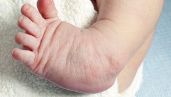 Baby with clubfoot | Experienced Idaho Podiatrist