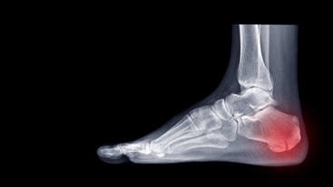 Calcaneal Fracture on the Heel of a Foot | Experienced Idaho Podiatrist