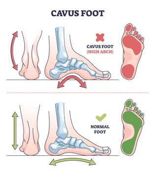 Cavus Foot Demonstration | Experienced Idaho Podiatrist