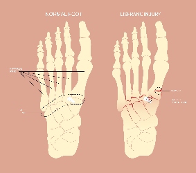 Diagram of foot with Lisfranc injury | Experienced Idaho Podiatrist