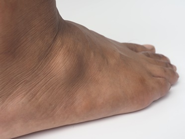 Ganglion Cyst on a Patients Foot | Experienced Idaho Podiatrist