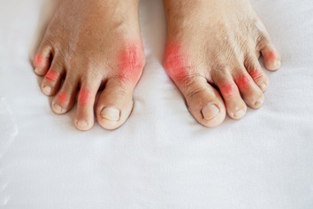 Gout in the Joints of a Foot | Experienced Idaho Podiatrist