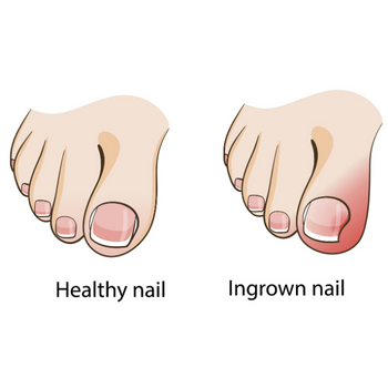 Ingrown nail | Experienced Idaho Podiatrist