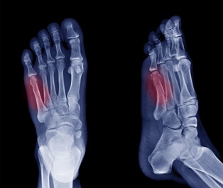 Jones Fracture X-Ray | Experienced Idaho Podiatrist