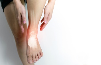 Swelling on the Top of the Foot From a Lisfranc Injury | Experienced Idaho Podiatrist