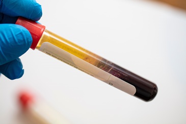 PRP Blood Vial | Experienced Idaho Podiatrist