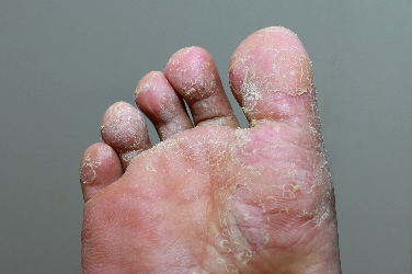 Person's foot with bad fungal infection | Experienced Idaho Podiatrist