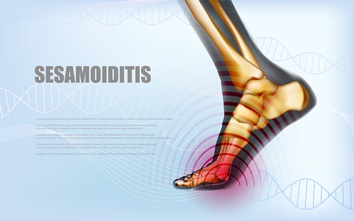Foot Sesamoiditis Illustration | Experienced Idaho Podiatrist