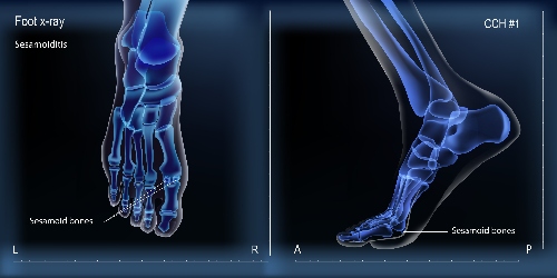 X-ray image of sesamoid bones in foot | Experienced Idaho Podiatrist
