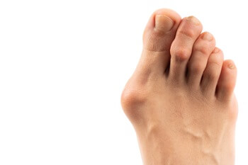 adult right foot with prominent bunion | Experienced Idaho Podiatrist