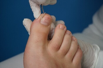 Child undergoing ingrown toenail surgery
