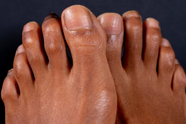 Close-up view of hammer toe | Experienced Idaho Podiatrist
