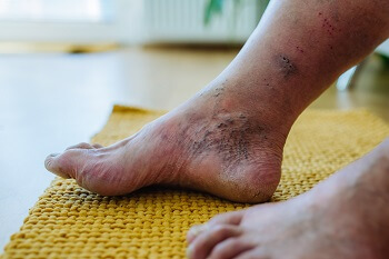 common diabetic foot complications including neuropathy and ulcers