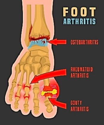 Illustration showing osteoarthritis, rheumatoid arthritis, and gouty arthritis in the foot