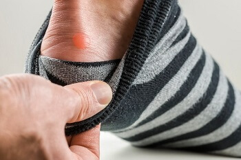 Man pulls down sock to reveal heel blister