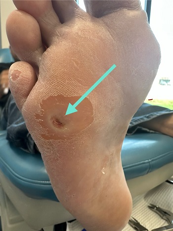 Foot ulcer on the sole associated with numbness and tingling concerns