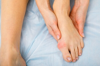 woman holding foot with bunion