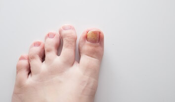 foot with fungus on the big toenail | Experienced Idaho Podiatrist