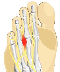 graphic-of-Mortons-Neuroma | Experienced Idaho Podiatrist