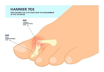 graphic of hammer toe showing bent joint