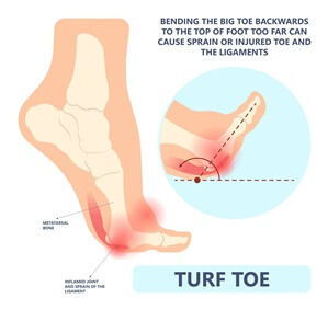 illustration of turf toe with inset | Experienced Meridian Idaho Podiatrist