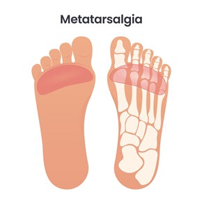 illustration showing metatarsalgia |Experienced Idaho Podiatrist