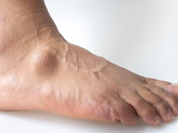 man with ganglion cyst on his foot | Experienced Idaho Podiatrist