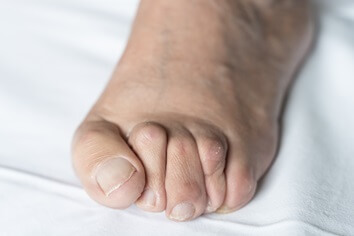 man with hammer toes | Experienced Idaho Podiatrist