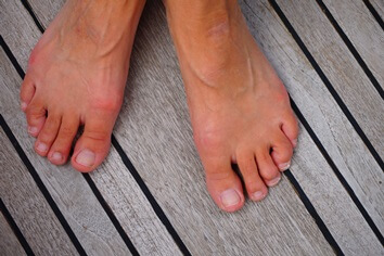 feet with mild hammer toes on wooden deck | Experienced Idaho Podiatrist