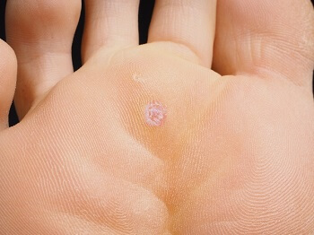 Close-up of a person protecting their feet in a locker room to avoid contagious plantar warts