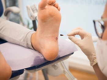 Podiatrist examining plantar wart on patient's foot