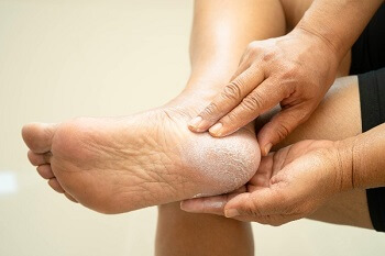 Person applying moisturizer to cracked heel for diabetic foot care
