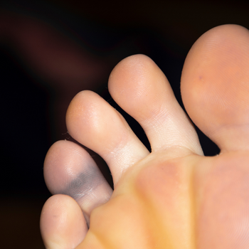 purple toe  | Experienced Idaho Podiatrist