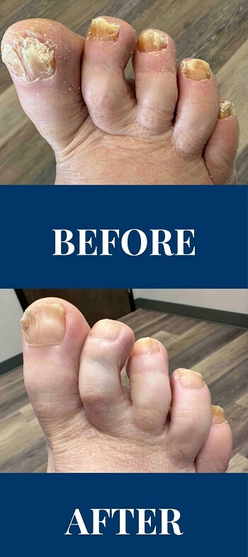 Before and after comparison of toenail fungus treatment results