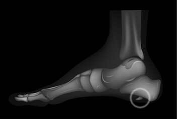 xray image showing heel bone spur | Experienced Idaho Podiatrist