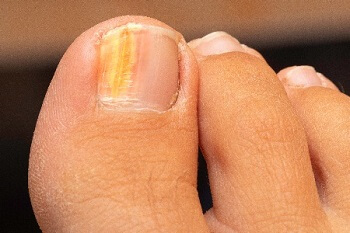 Close-up of yellow toenail discoloration before podiatrist treatment